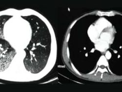 Deteksi Dini Kanker Paru di RSUP Persahabatan, Berikut Tarifnya