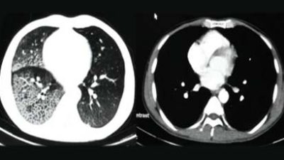 Berikut 4 Cara Kurangi Resiko Kanker