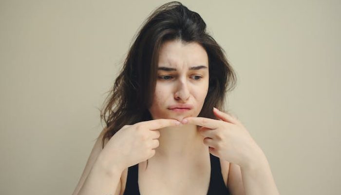 Bruntusan dan Jerawat? Coba Cara Alami Ini Untuk Hilangkannya