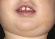 Catat! Ini Gejala dan Penyebab Gondongan