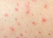 Catat! Ini 7 Mitos dan Fakta Tentang Cacar Monyet yang Perlu Kamu Ketahui